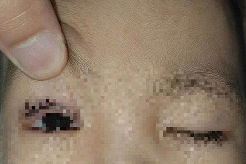 Bé trai 2 tuổi nhập viện vì bỏng mắt do pháo hoa Trung thu