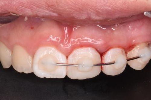 Xử trí chấn thương răng cửa như thế nào?