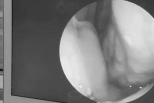 Người đàn ông 60 tuổi liên tục chảy máu mũi, bác sĩ gắp ra thứ 'đáng sợ' bên trong