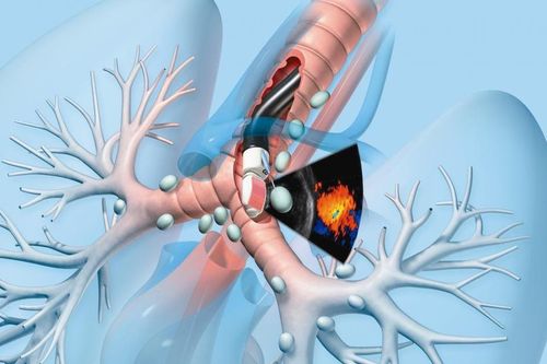 Bước phát triển mới của kỹ thuật nội soi hô hấp Việt Nam