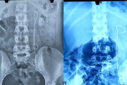 Nữ bệnh nhân bị bỏ quên thiết bị y tế trong cơ thể suốt 15 năm