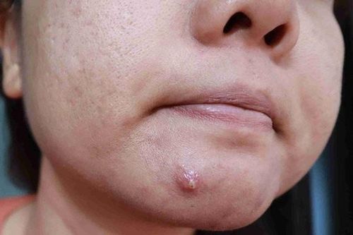 Cách xử lý mụn bọc sưng to an toàn, hạn chế thâm sẹo