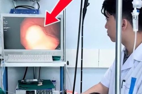 Đi khám vì ho, người đàn ông phát hiện u mô đệm dạ dày nguy hiểm