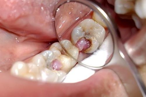 Biến chứng nguy hiểm của viêm tủy răng