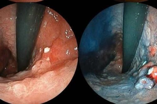 Những 'thủ phạm' âm thầm nuôi dưỡng ung thư dạ dày