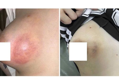 Cô gái 20 tuổi bị áp xe vú nặng sau khi tiêm chất làm đầy không rõ nguồn gốc