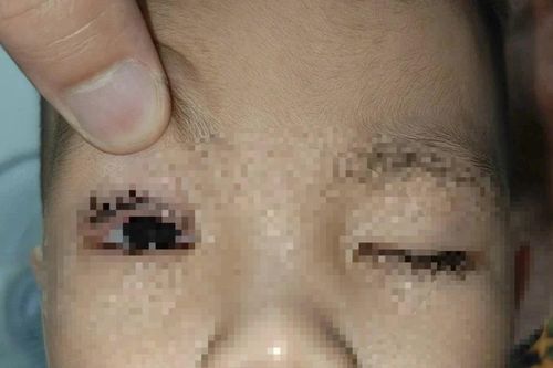 Trẻ 2 tuổi bị pháo hoa bắn trúng mắt