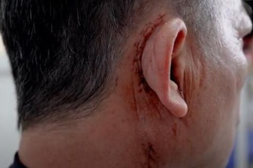 Loại bỏ khối u chung sống 10 năm gây liệt mặt