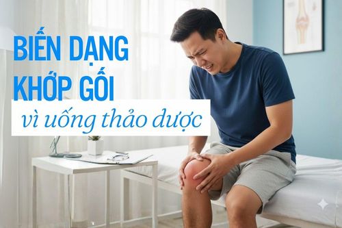 Người đàn ông 37 tuổi bị biến dạng khớp gối vì uống thảo dược có chất cấm nguy hiểm