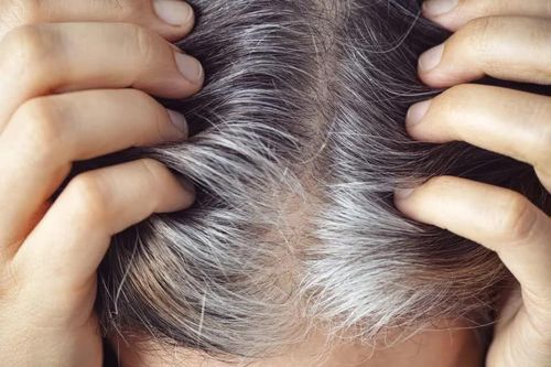 Nguyên nhân khiến tóc bạc sớm ở người trẻ