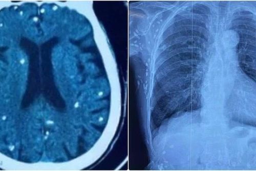 Nang sán dây lợn gây vôi hóa đầy cơ thể