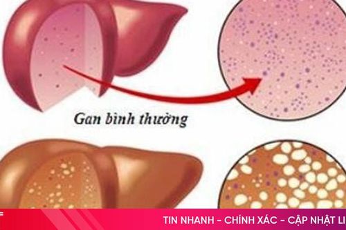 Những điều cần biết về gan nhiễm mỡ