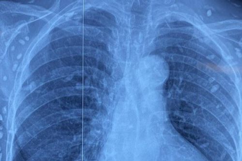 Rối loạn ý thức, người phụ nữ được chẩn đoán nhiễm ấu trùng sán dây lợn