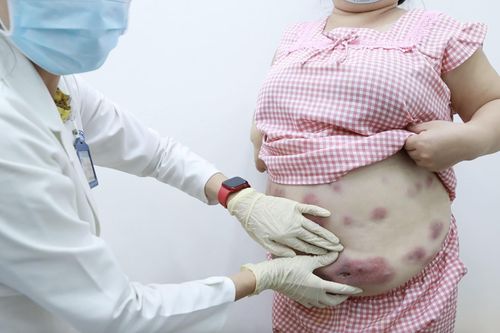 Nhiều phụ nữ gặp biến chứng nặng do tiêm tan mỡ trôi nổi