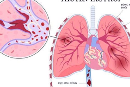 Thuyên tắc phổi ở người hút thuốc lá và những người có nguy cơ mắc căn bệnh nguy hiểm này