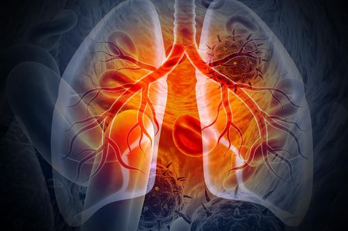 9 dấu hiệu cảnh báo sớm của bệnh ung thư phổi