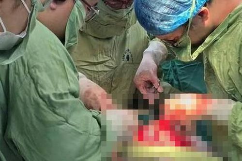 Tự uống thuốc phá thai tại nhà, cô gái 27 tuổi vỡ tử cung
