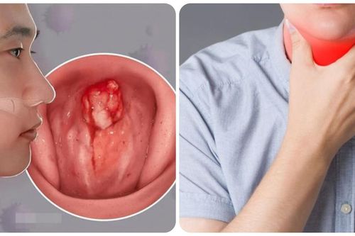 9 dấu hiệu ung thư vòm họng giai đoạn đầu