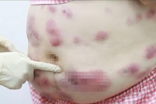 Hình ảnh gây sốc sau khi một phụ nữ ở TP.HCM tiêm tan mỡ