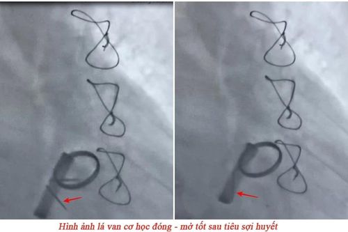 Cứu bệnh nhân 69 tuổi ở Quảng Ninh bị huyết khối kẹt van tim nhân tạo