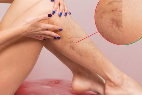 Bác sĩ cảnh báo: 80% ca huyết khối tĩnh mạch sâu không có triệu chứng, phát hiện thì đã quá muộn