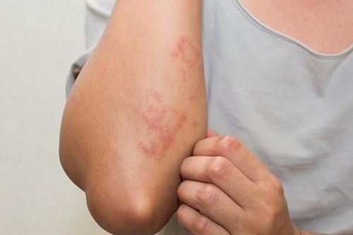 Mẩn đỏ, ngứa khắp người là biểu hiện của bệnh gì?