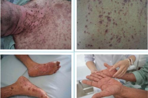 Tự dùng thuốc gút người bệnh dị ứng toàn thân nghiêm trọng
