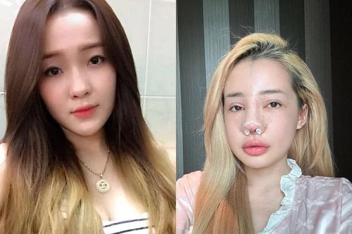 10 năm qua, Ngân 98 từng 'nghiện' phẫu thuật thẩm mỹ ra sao?