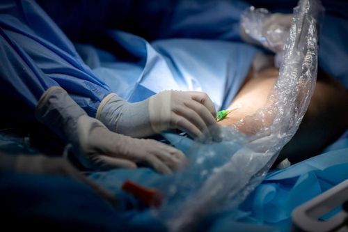 Điều trị suy giãn tĩnh mạch bằng cách xơ hóa tĩnh mạch suy