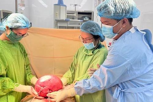 Người phụ nữ mang khối u xơ tử cung nặng 4,5kg vì sai lầm này trong suốt nhiều năm