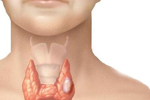 Lý do khiến bạn dễ mắc u tuyến giáp