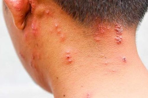 'Đắp lá' hay điều trị zona thần kinh theo mẹo dân gian có thể đe dọa tính mạng