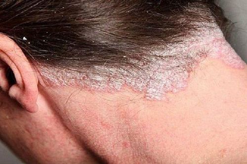 Ai dễ bị nhiễm nấm da đầu, biểu hiện nấm da đầu?