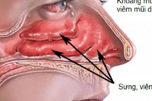 Dùng thuốc trị viêm mũi dị ứng: Giảm nhanh triệu chứng, nhưng cần dùng đúng cách