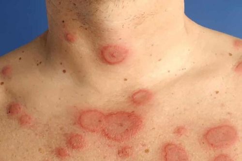 Phát hiện kịp thời trẻ mắc lupus ban đỏ hệ thống