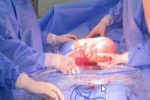 Cặp song sinh ở Quảng Ninh chào đời còn nguyên trong bọc điều