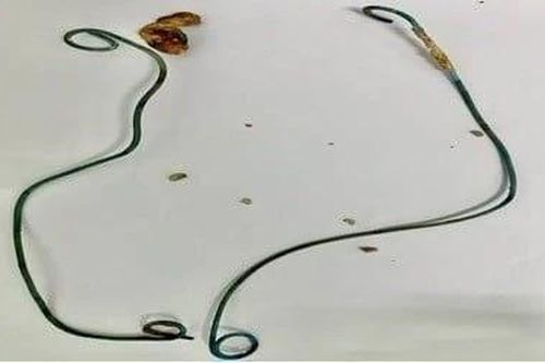 Bỏ quên không rút thông JJ khiến sỏi thận bám đầy