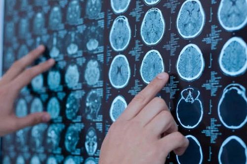 Trung Quốc thử nghiệm lâm sàng giai đoạn 3 thuốc điều trị ung thư não