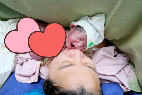 Hiếm gặp: Bé gái mắc hội chứng truyền máu song thai - một thai không tim