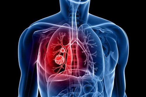 5 dấu hiệu liên quan đến ung thư phổi không nên bỏ qua