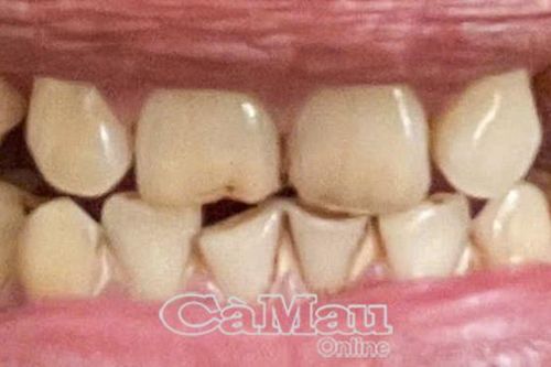 Thuốc lá gây nhiều bệnh lý về răng miệng