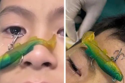Bé trai ở Bắc Ninh bị móc câu cá đâm xuyên nhãn cầu