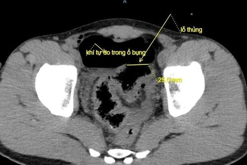 Cấp cứu thành công ca thủng đại tràng do bị vòi rửa xe xịt vào hậu môn