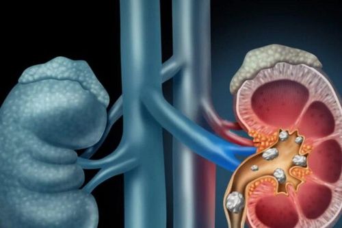 Bệnh sỏi thận và những biến chứng nguy hiểm không thể chủ quan