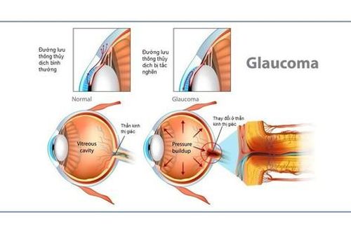 Biểu hiện sớm của bệnh glôcôm