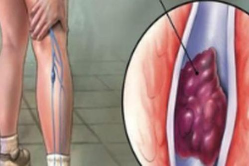Ngồi lâu: Nguy cơ cục máu đông nguy hiểm, cách nào phòng ngừa hiệu quả?