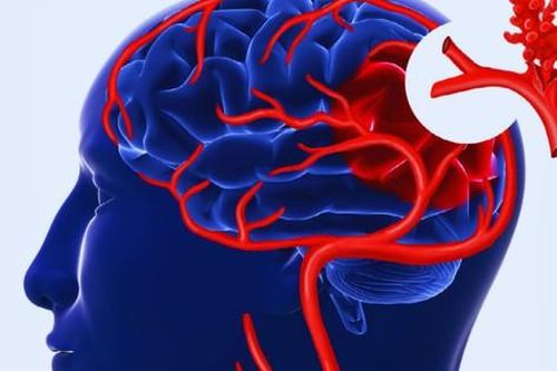 Triệu chứng bệnh teo não ở người già