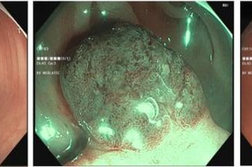 Thường xuyên rối loạn đại tiện, người đàn ông 52 bất ngờ phát hiện mắc u tuyến ống
