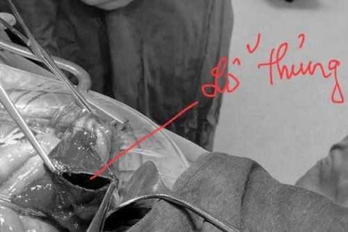 Dùng vòi rửa xe ô tô xịt vào hậu môn, phải nhập viện cấp cứu do thủng đại tràng