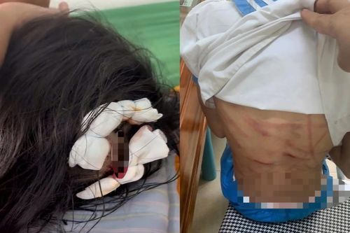 Xác minh vụ bé gái lớp 5 nghi bị cha dượng bạo hành dã man